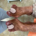 siliconas podológicas a medida