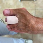 siliconas podológicas a medida