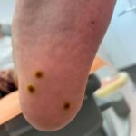 verrugas plantares papilomas