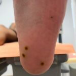 verrugas plantares papilomas