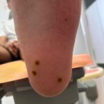 verrugas plantares papilomas